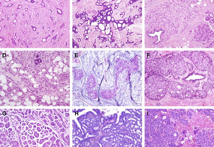 Breast Cancer Detection using Deep Learning – speeding up histopathology